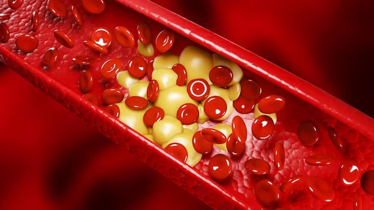 ayurvedic-home-remedies-to-reduce-ldl-cholesterol-naturally-5