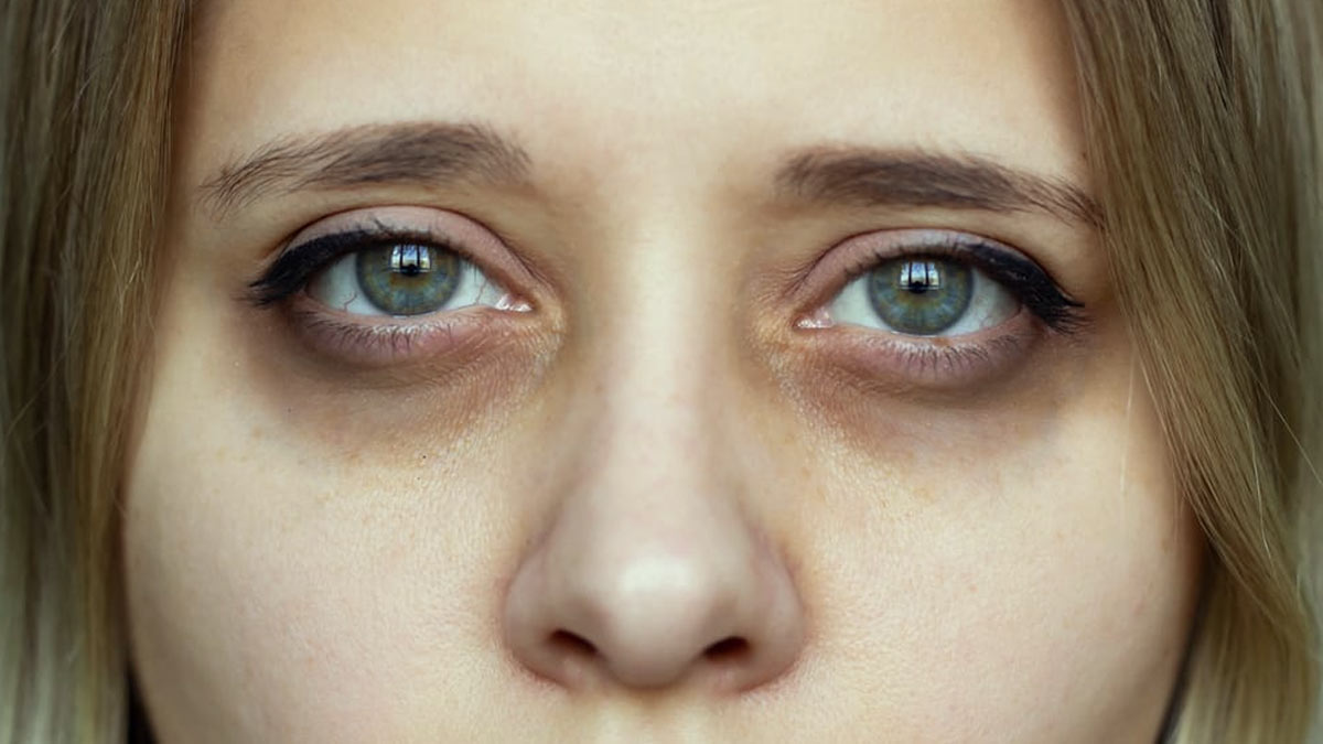 remedies-of-dark-circles-1732118948251 (1)