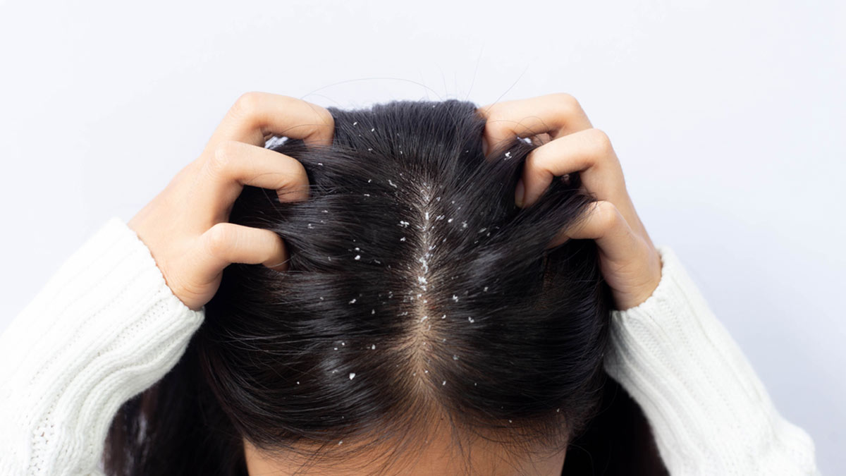 tips-for-dandruff-1744307031508