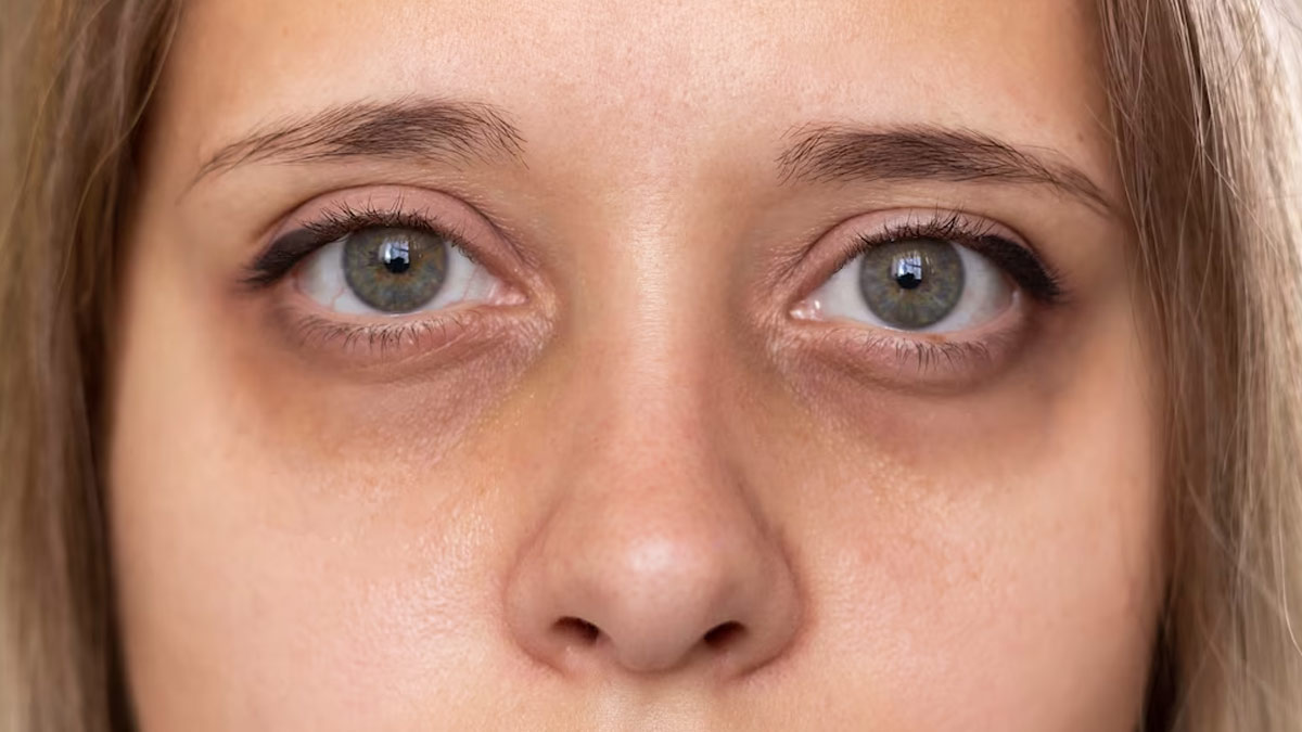 eye-dark-circle-tips
