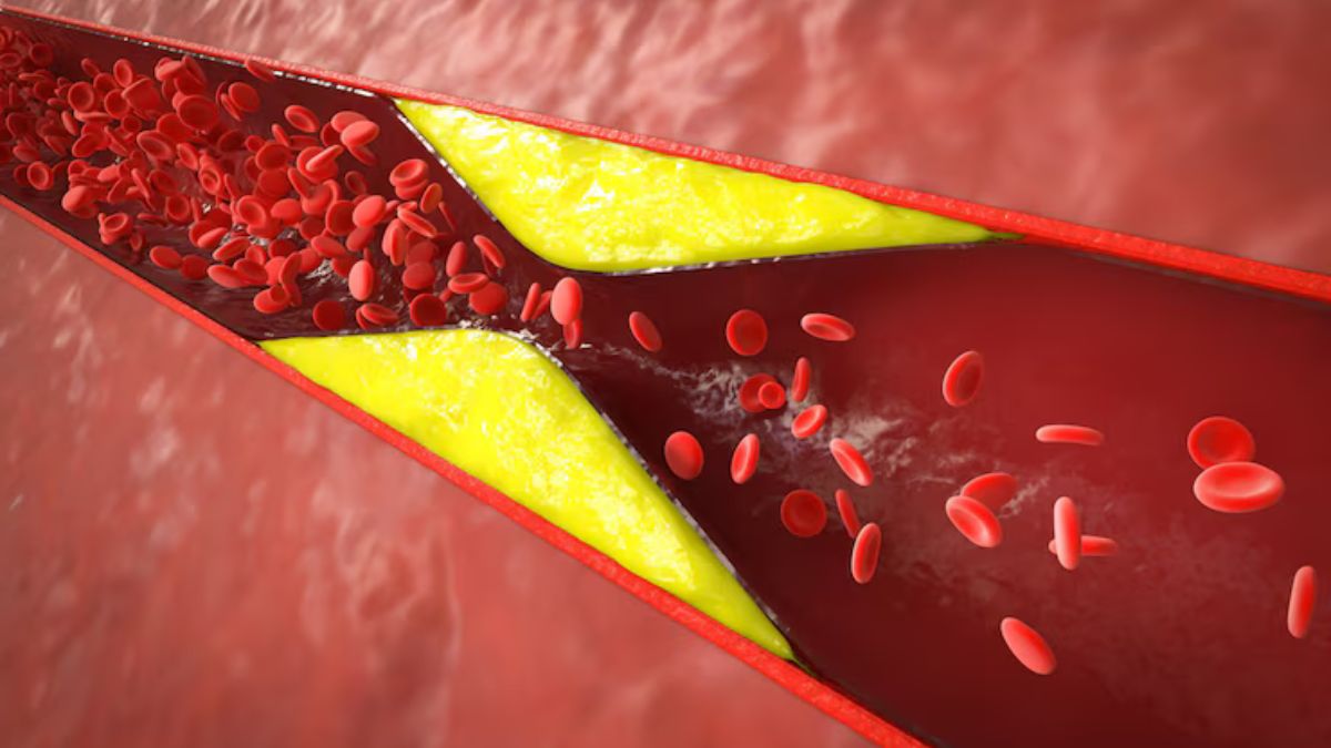 home-remedies-to-help-reduce-dirt-and-bad-cholesterol-in-the-veins-1745673058356