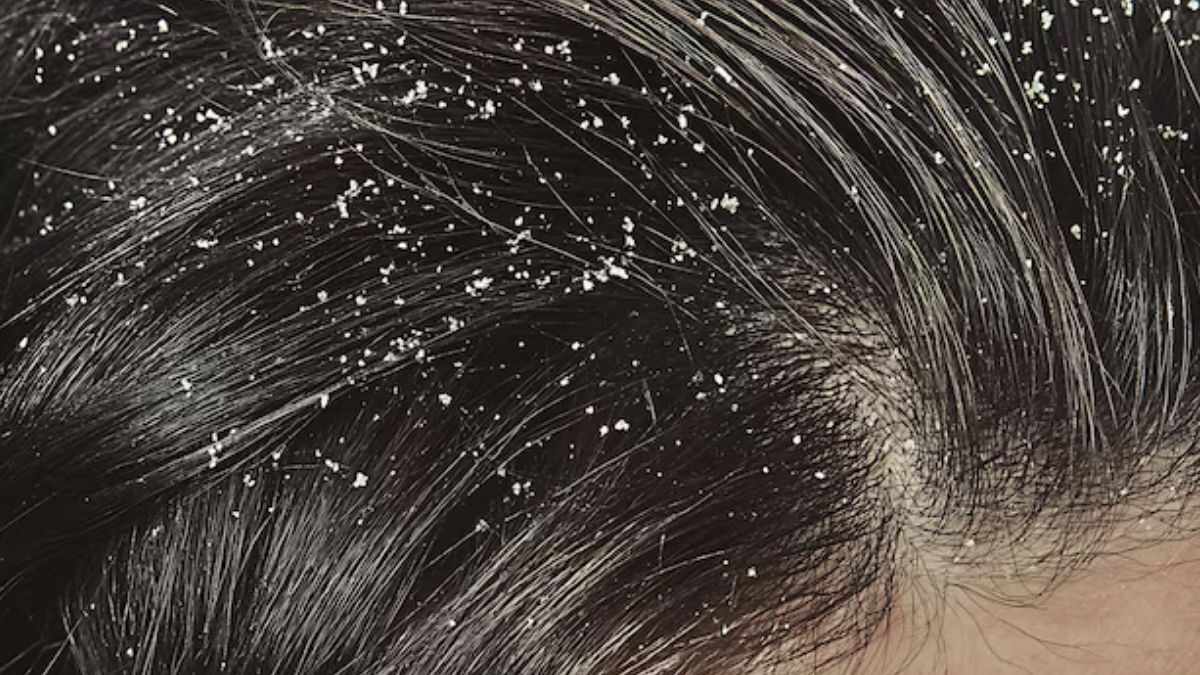 dandruff-(1)-1740927632172 (1)