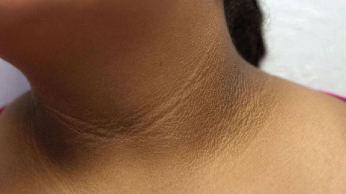 dark neck