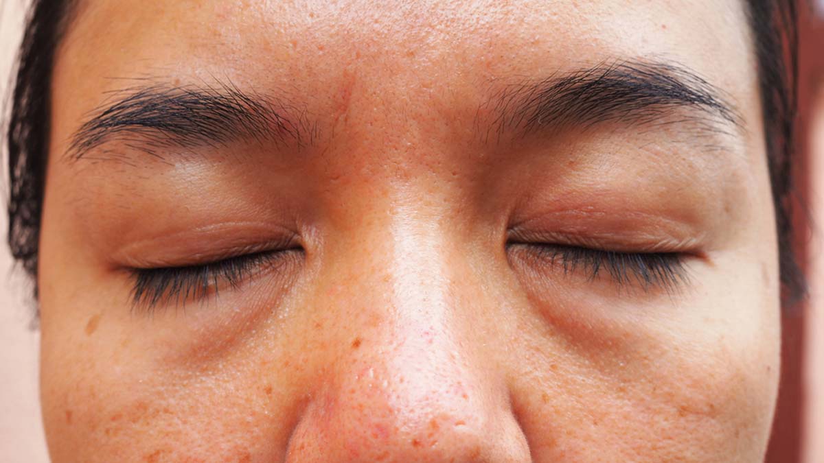 how-to-deal-with-inflamed-skin