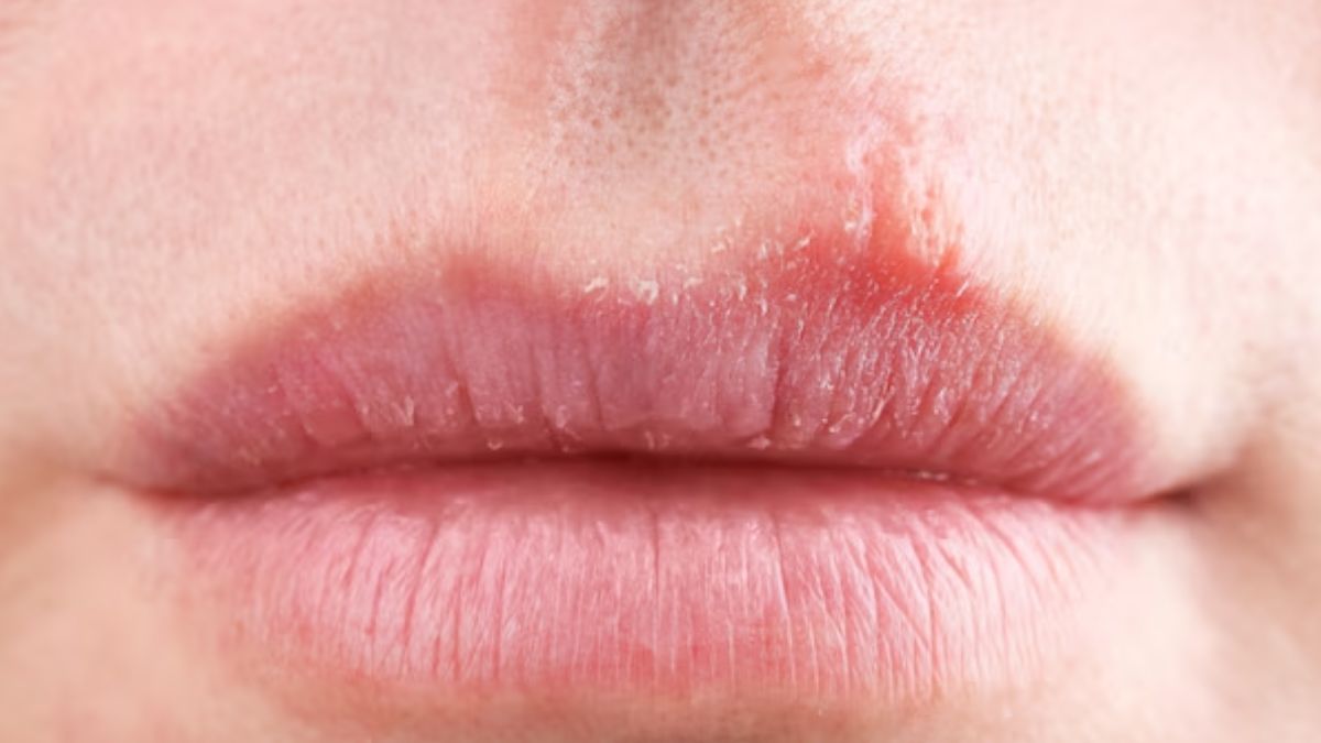 dry lips 1