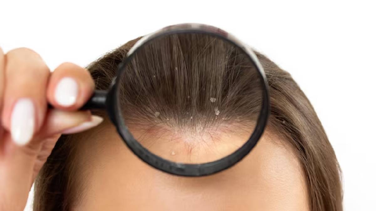 Dandruff Home Remedies