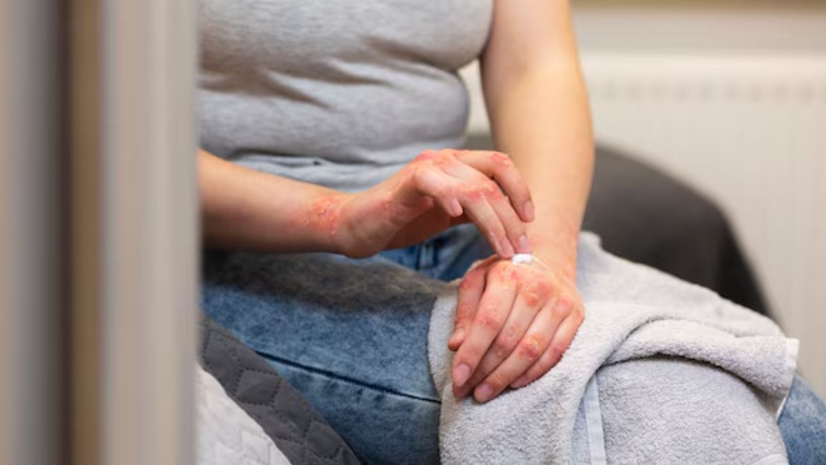 Winter Psoriasis Problems: குளிர்காலத்தில் சொரியாசிஸ் பிரச்சனை அதிகரிப்பதற்கான முக்கிய காரணங்கள் தெரியுமா?