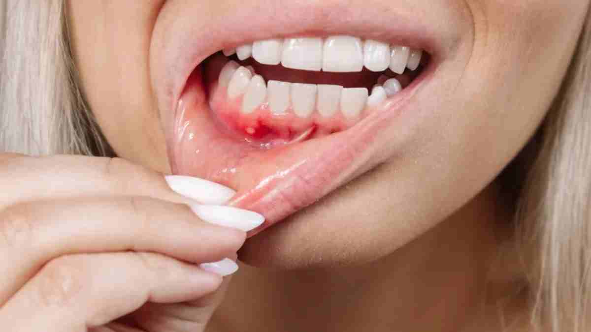 Mouth Ulcer: வாய்ப்புண் பாதிப்பால் அவதிப்படுகிறீர்களா? இதோ உங்களுக்கான எளிய வீட்டு வைத்தியம்!
