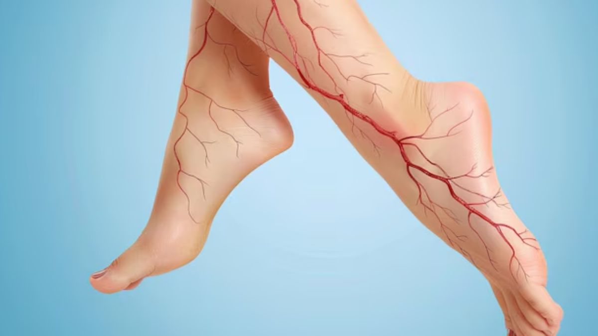 வெரிகோஸ் வெயின்ஸ் பிரச்சனை இருப்பவர்கள் இந்த 3 விஷயங்களை உணவில் சேர்த்துக்கொள்ளுங்கள்