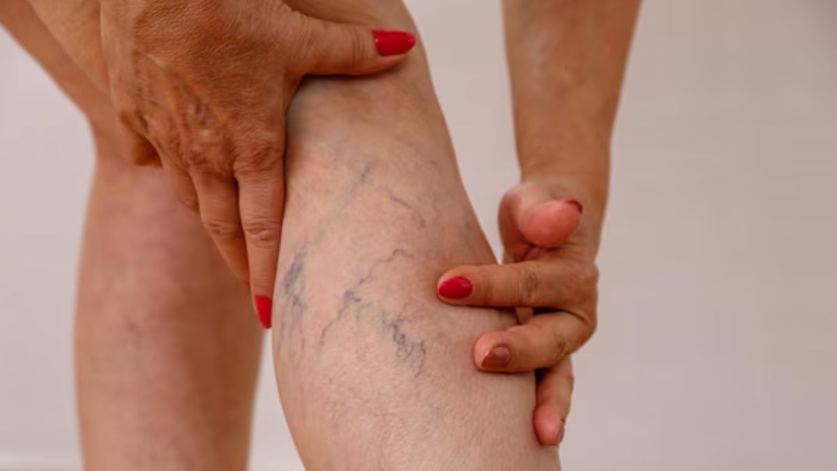 Varicose vein 1