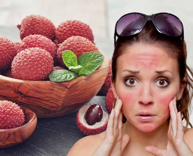 LYCHEE HAIR SKIN sunburn