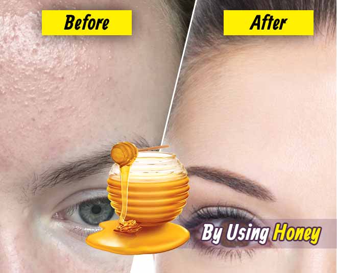 Best Honey Face Mask For Glowing Skin Heat Rash