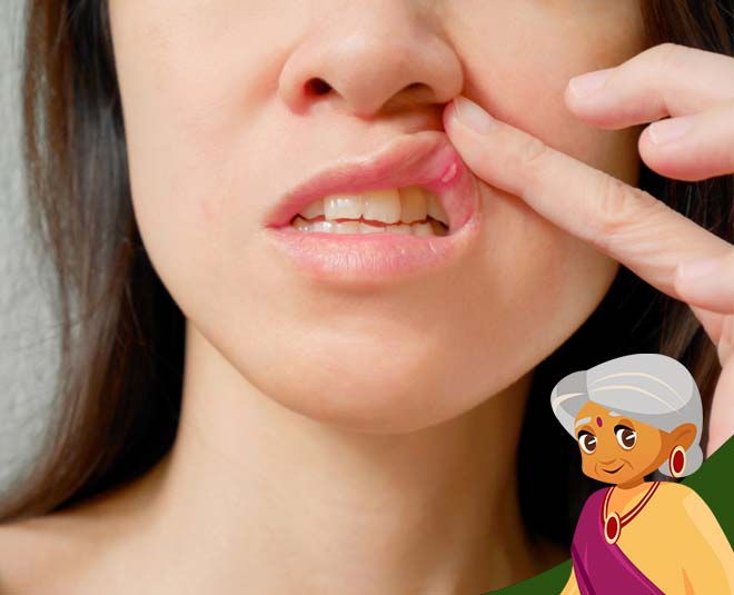 mouth ulcer health inside