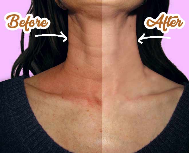 neck wrinkles remedies main
