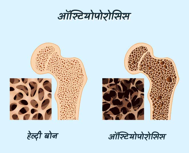 Osteoporosis problem
