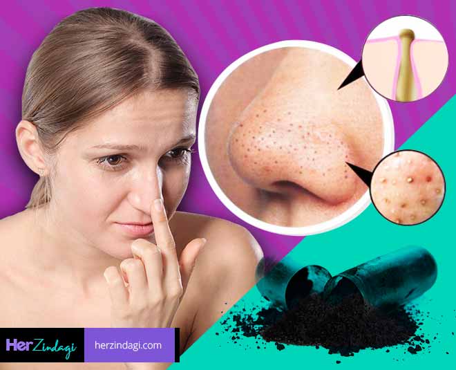 blackheads removal home remedies article