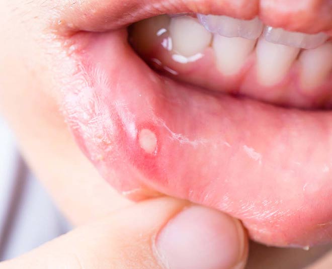mouth ulcer health inside