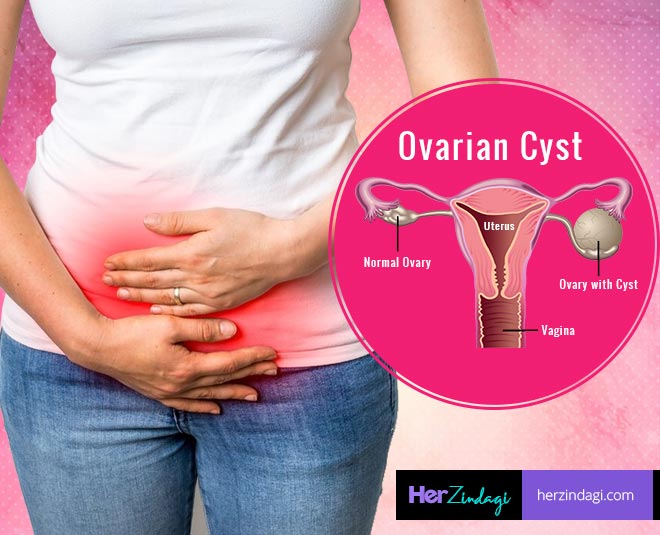 Deal With Ovarian Cyst With This Magic Potion