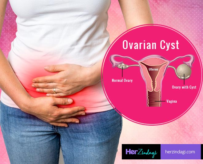 deal-with-ovarian-cyst-with-this-magic-potion-herzindagi