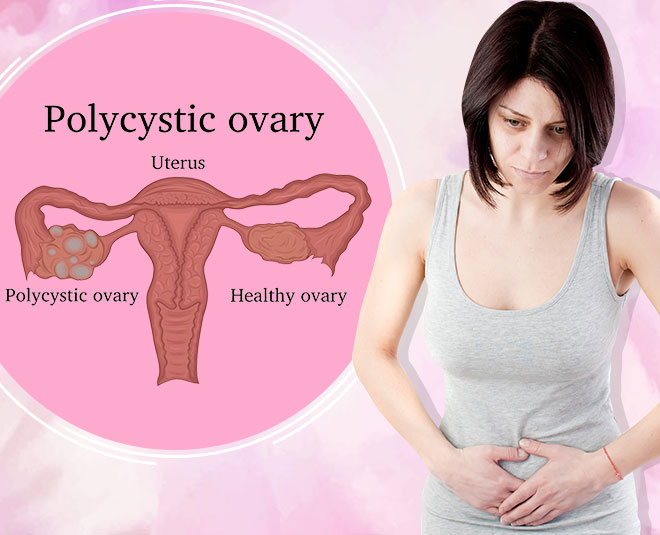 polycystic ovary syndrome symptoms causes treatment weight gain article
