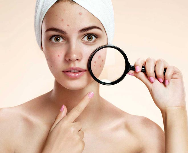 Pimples cure skin problem treatment inside