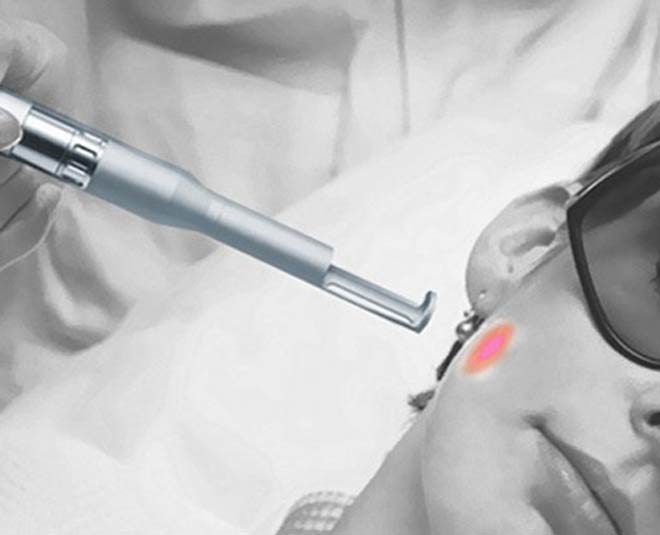 लेज़र Remove Unwanted Hair From Body Permanently for Female INSIDE