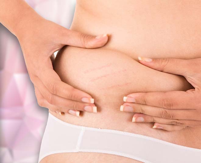 stretch marks facts e