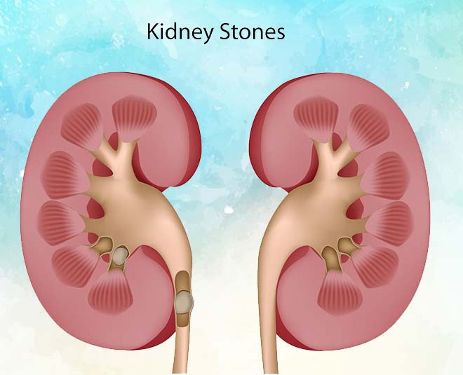 kidney stone beer health Inside