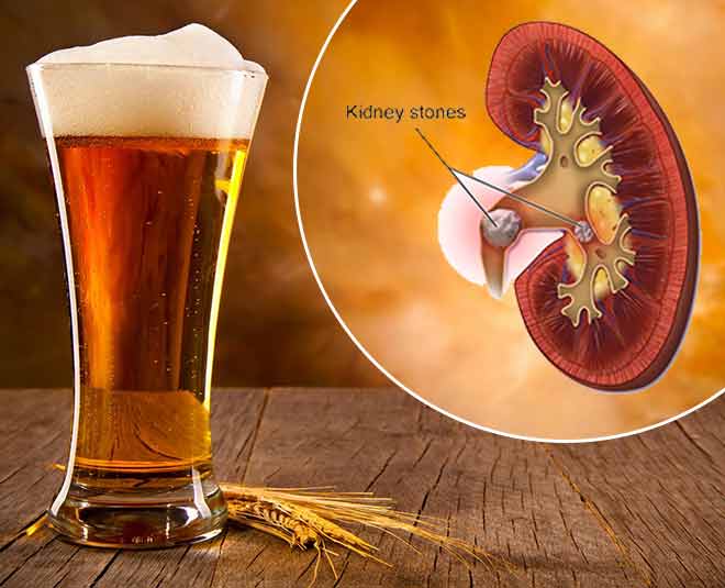 Is Beer Good For Kidney Stone Health Benefits in Hindi | is beer good for  kidney stone health benefits | HerZindagi