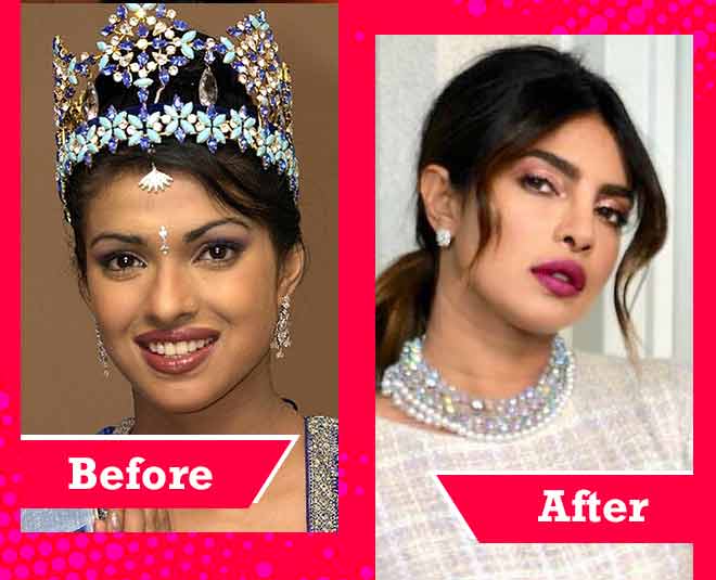 bollwood actress cosmetic surgery priyanka chopra