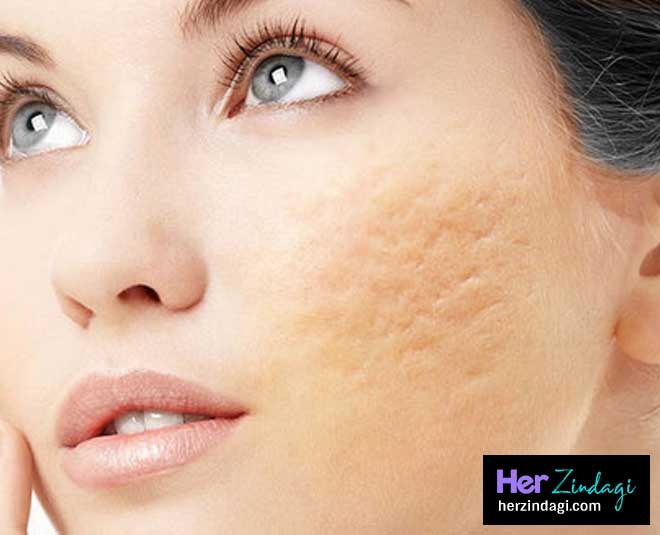 face scars remove byhomemade mask inside 