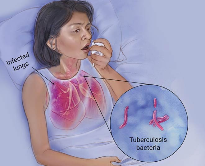 stay-safe-from-the-dangers-of-tuberculosis-stay-safe-from-the-dangers