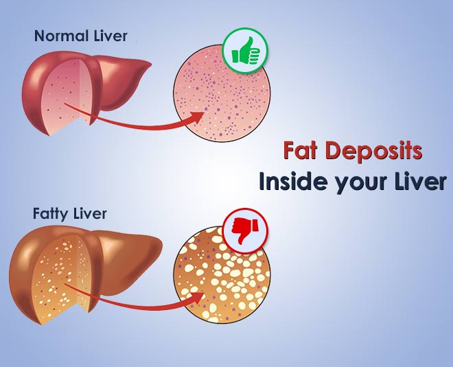 fatty liver INSIDE 