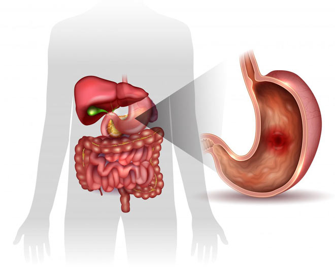 stomach ulcer health 