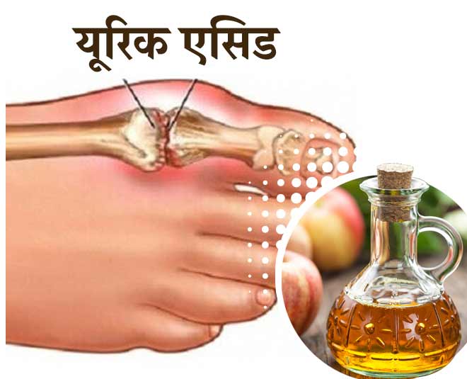 यूरिक एसिड लेवल कम करें Benefits Of Apple Cider Vinegar For Skin Hair And Health in