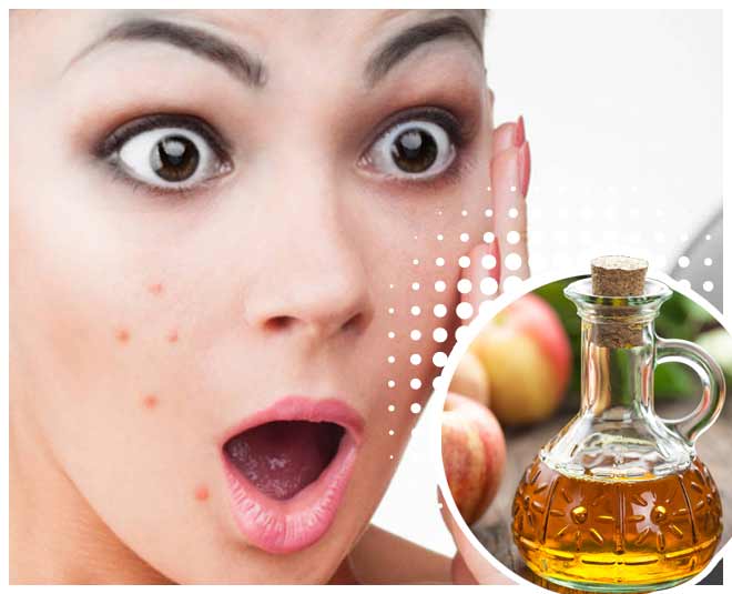 मुहांसों से निजात दिलाये Benefits Of Apple Cider Vinegar For Skin Hair And Health in