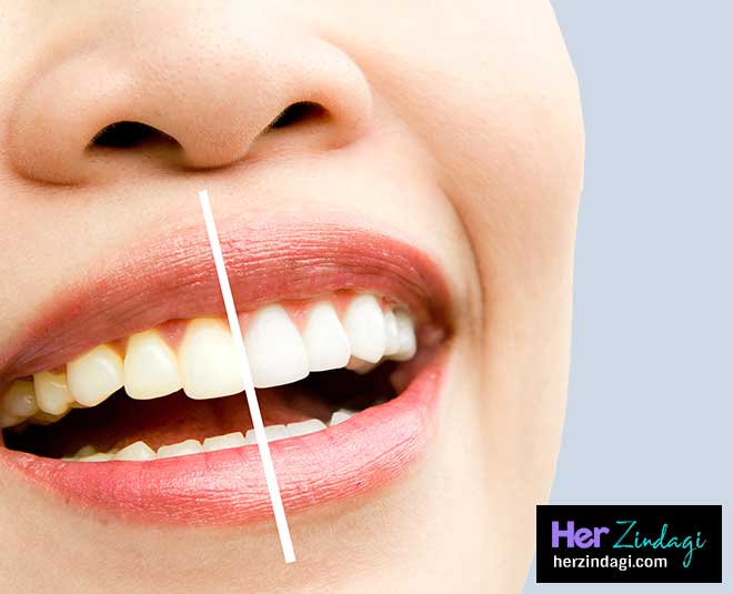 Teeth Whitening Hydrogen Peroxide