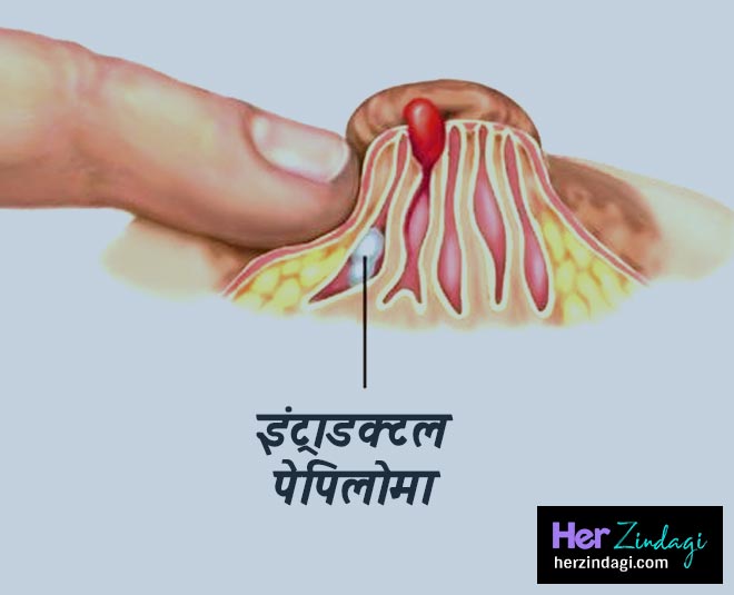 blood coming with breast milk during breastfeeding inside 