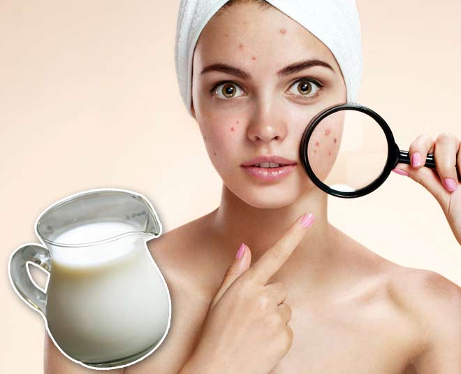 butter milk acne problem