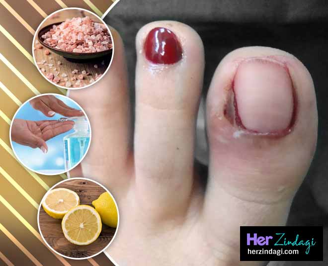 Ingrown Toenails Pain Relief Home Remedies Tips In Hindi | ingrown toenails  pain relief home remedies tips | HerZindagi