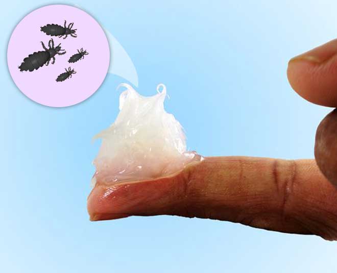 lice problem in summer cinsideard