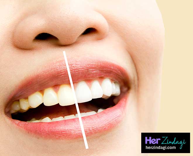 pros cons teeth whitening or bleaching inside 