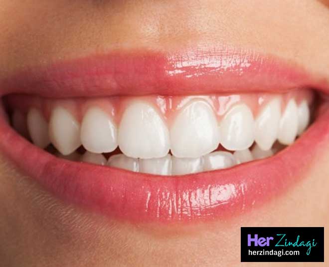 pros cons teeth whitening or bleaching inside 