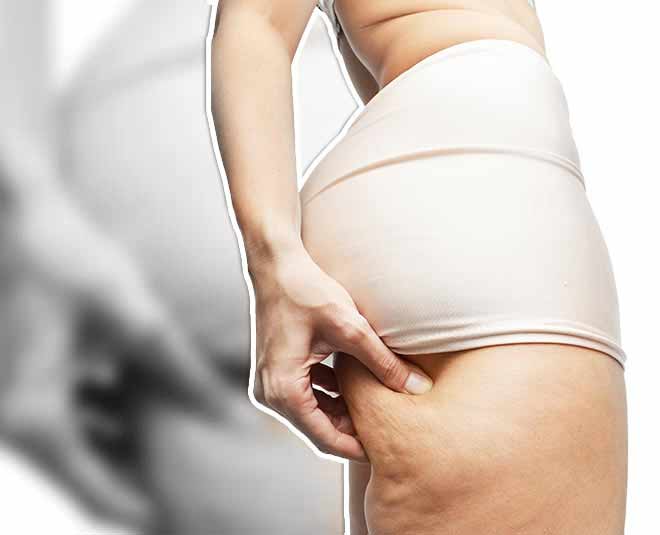 skin problem cellulite in