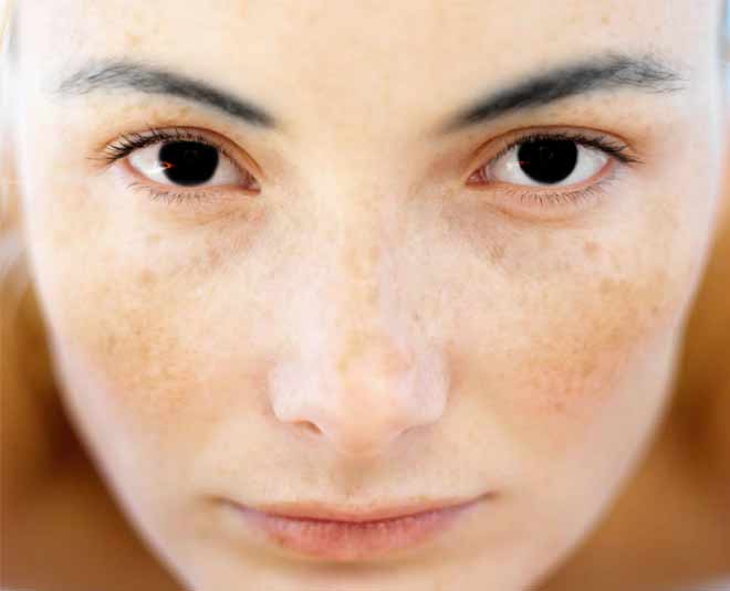 skin problem pigmention in