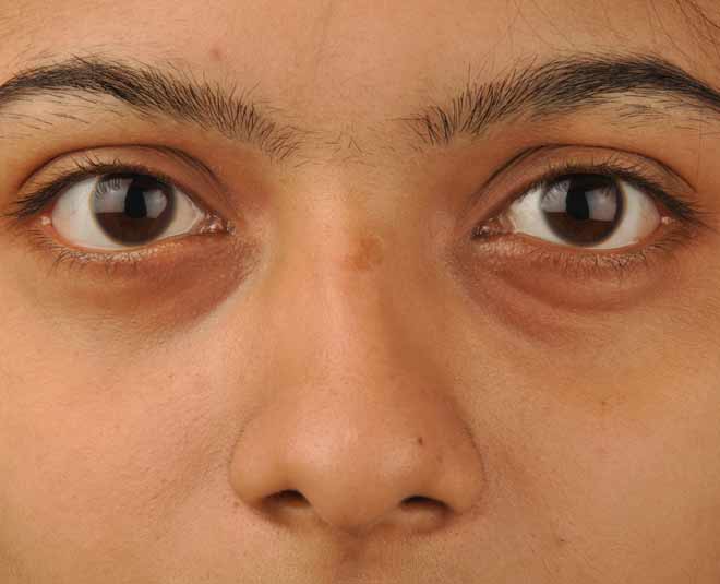 skin problem puffy eyes in