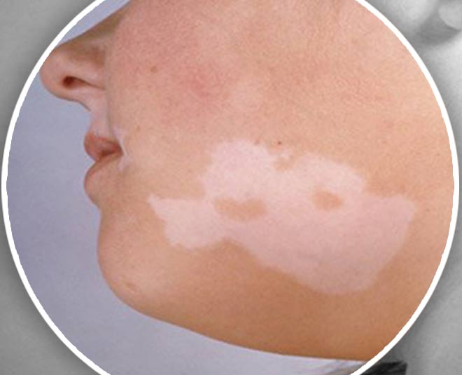 लड़कियों के लिए अभिशाप है यह बीमारी these home remedies can cure vitiligo easily inside