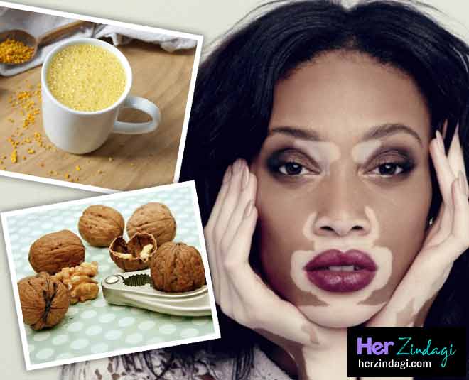 these home remedies can cure vitiligo easily main