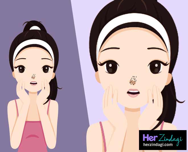 ब्लैकहेड्स दूर करे this one ingredient will cure blackheads tanning and sunburn inside
