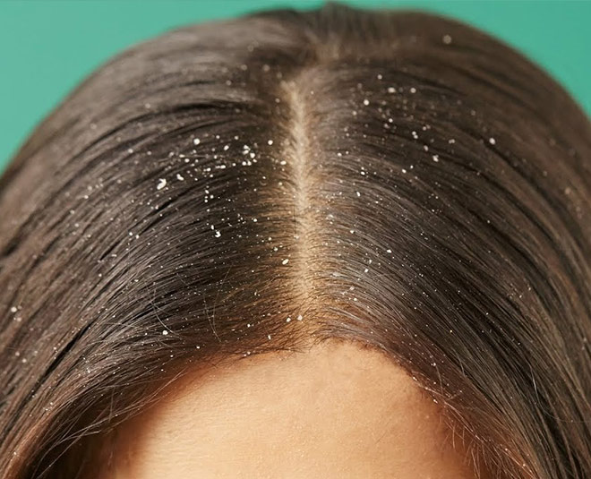 dandruff problem solution inside
